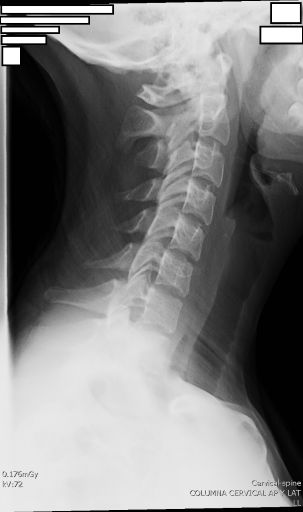 LAT Cervical Radiograph